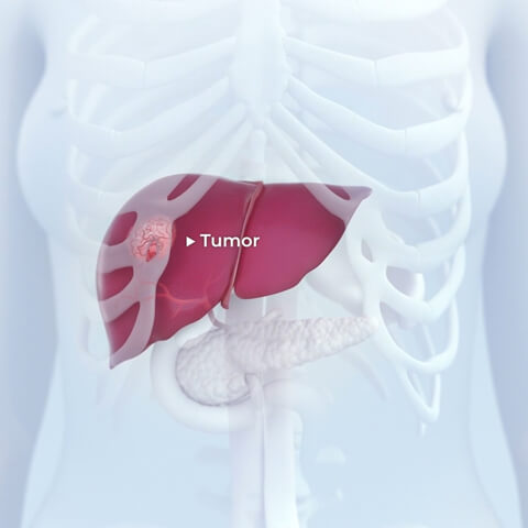 Tumor sited in the liver, in body context