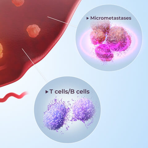 Micrometastases with T cells and B cells