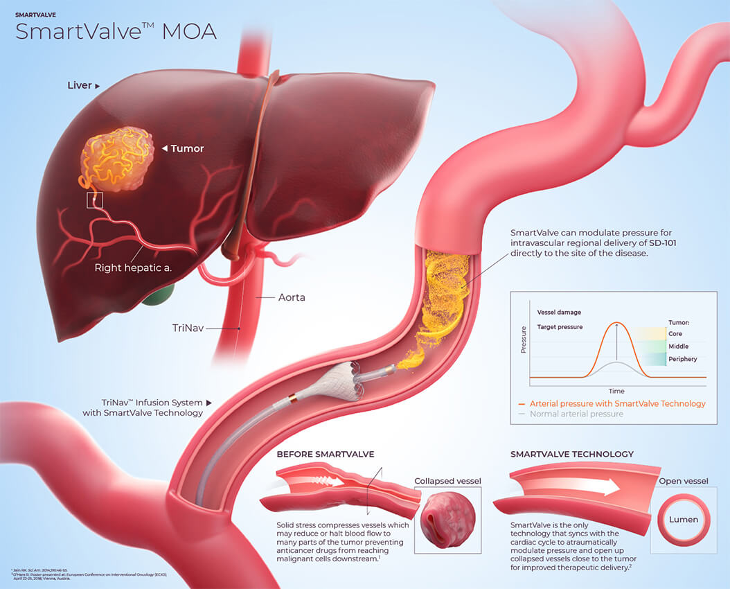Pressure-enabled drug delivery figure showing the TriNav infusion system with SmartValve technology
