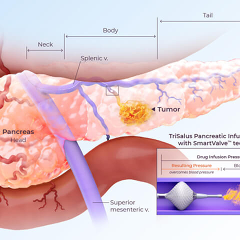 Pancreatic infusion with SmartValve, annotated