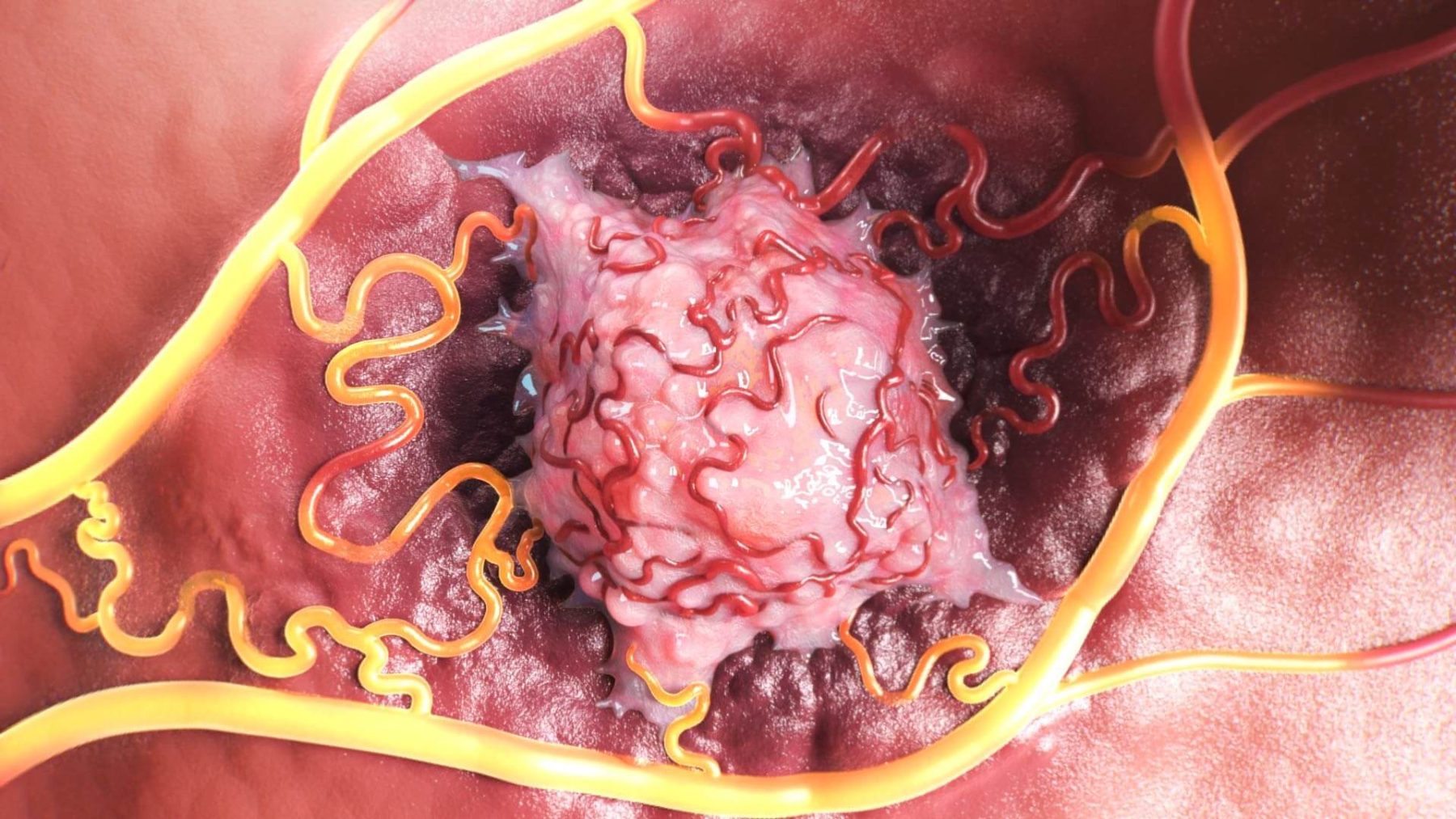 Tumor microenvironment with a perfused vessel carrying therapy, from the TriSalus mechanism films